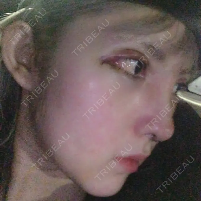 鼻尖形成（切開） / 鼻中隔延長（切開） / 眉間プロテーゼ / 鼻修正 FROM B整形外科 (旧バウム整形外科) DAY 4 メイン用