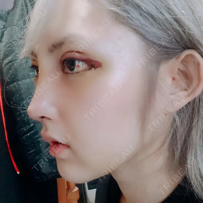 鼻尖形成（切開） / 鼻中隔延長（切開） / 眉間プロテーゼ / 鼻修正 FROM B整形外科 (旧バウム整形外科) DAY 5 メイン用