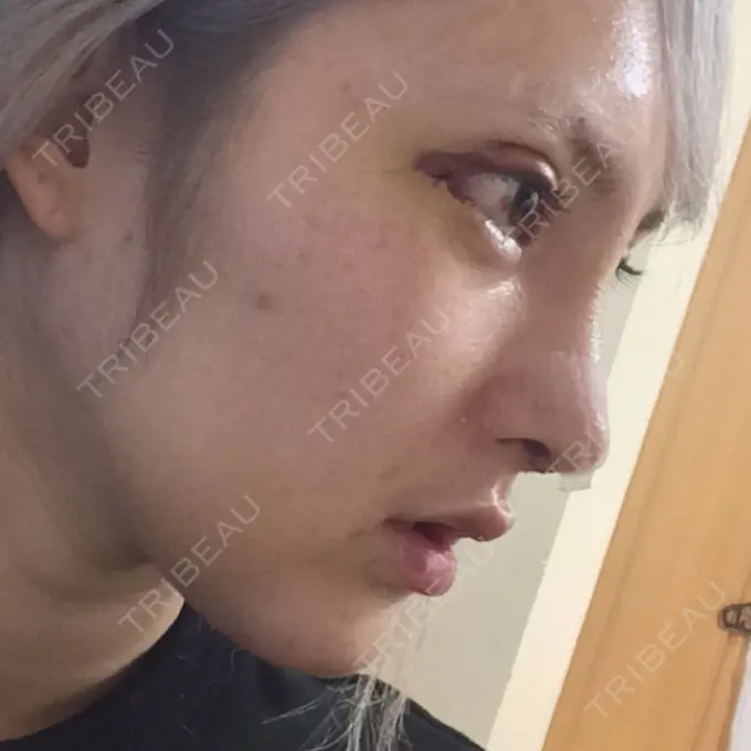 鼻尖形成（切開） / 鼻中隔延長（切開） / 眉間プロテーゼ / 鼻修正 FROM B整形外科 (旧バウム整形外科) DAY 5 メイン用