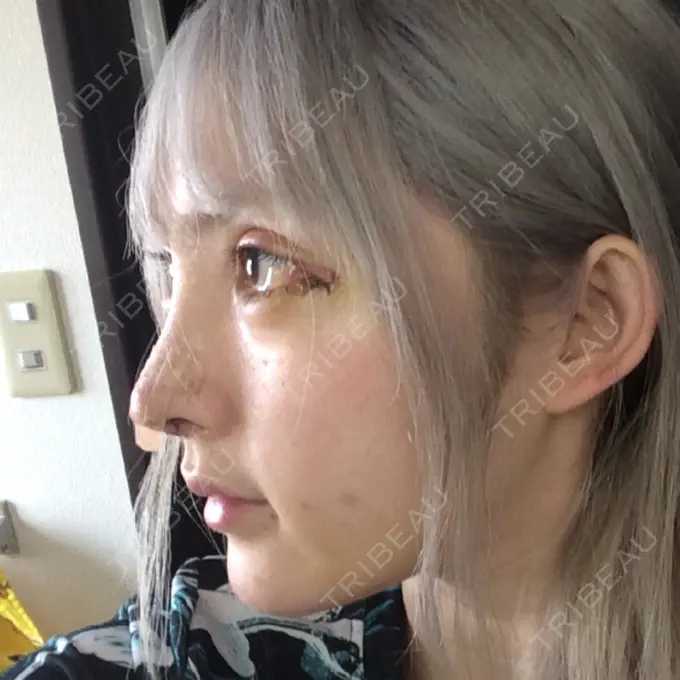 鼻尖形成（切開） / 鼻中隔延長（切開） / 眉間プロテーゼ / 鼻修正 FROM B整形外科 (旧バウム整形外科) DAY 6 メイン用