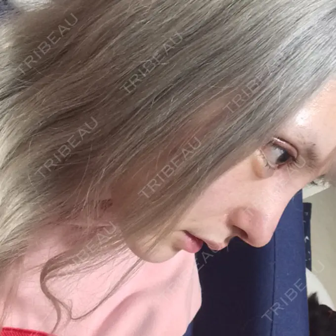 鼻尖形成（切開） / 鼻中隔延長（切開） / 眉間プロテーゼ / 鼻修正 FROM B整形外科 (旧バウム整形外科) DAY 8 メイン用