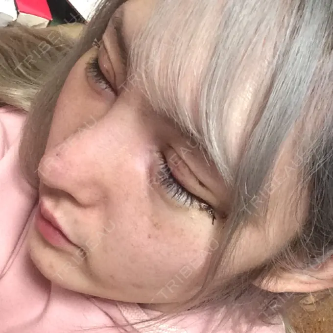 鼻尖形成（切開） / 鼻中隔延長（切開） / 眉間プロテーゼ / 鼻修正 FROM B整形外科 (旧バウム整形外科) DAY 8 メイン用