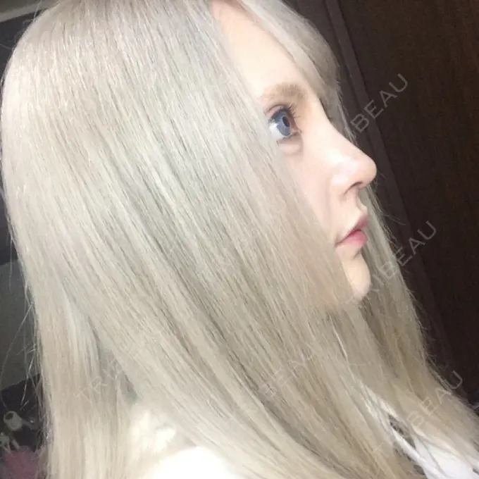 鼻尖形成（切開） / 鼻中隔延長（切開） / 眉間プロテーゼ / 鼻修正 FROM B整形外科 (旧バウム整形外科) DAY 15 メイン用