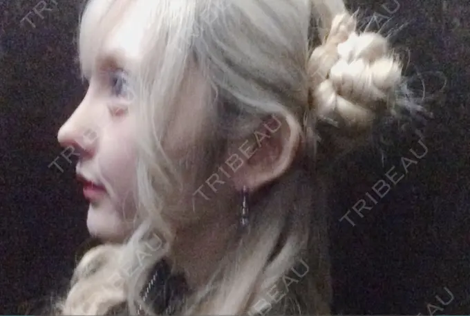 鼻尖形成（切開） / 鼻中隔延長（切開） / 眉間プロテーゼ / 鼻修正 FROM B整形外科 (旧バウム整形外科) AFTER メイン用