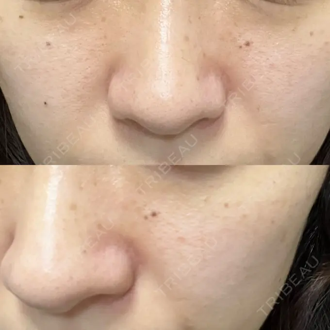 イオン導入 / 毛穴洗浄（ハイドラフェイシャルなど） / ルメッカ ルラ美容クリニック 大宮院 / ルラスキンクリニック 大宮院 AFTER メイン用