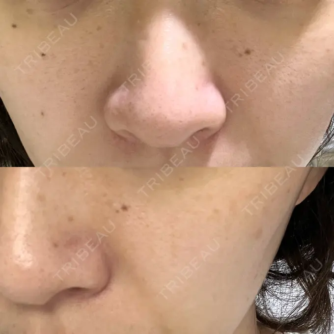 イオン導入 / 毛穴洗浄（ハイドラフェイシャルなど） / ルメッカ ルラ美容クリニック 大宮院 / ルラスキンクリニック 大宮院 DAY 26 メイン用