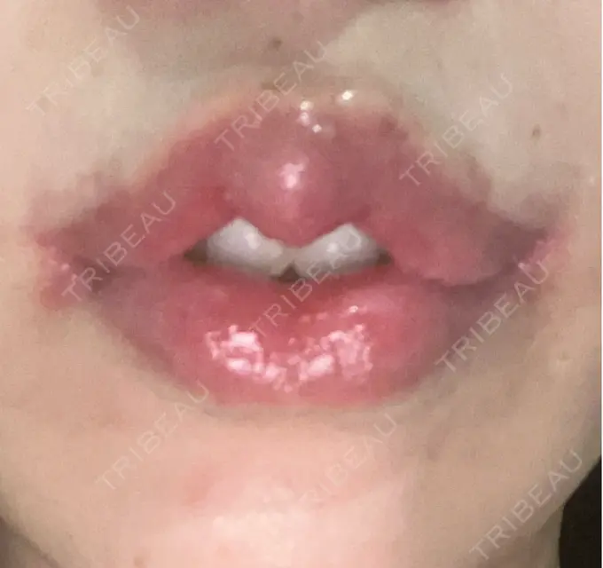 人中短縮 / 口角挙上 / その他（口元） R Beauty CLINIC 銀座院 DAY 22 メイン用