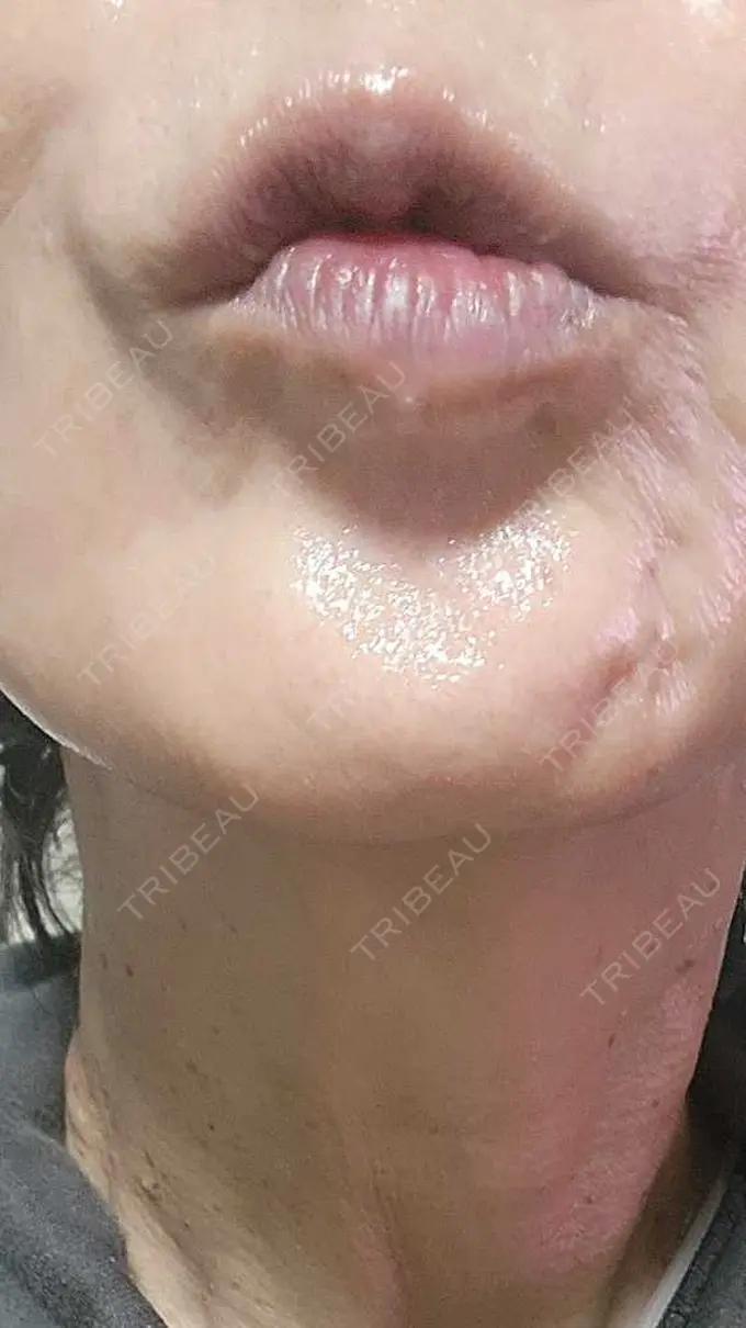 ボトックス（眉間） / ボトックス（目尻） ルラ美容クリニック 広島院 AFTER メイン用