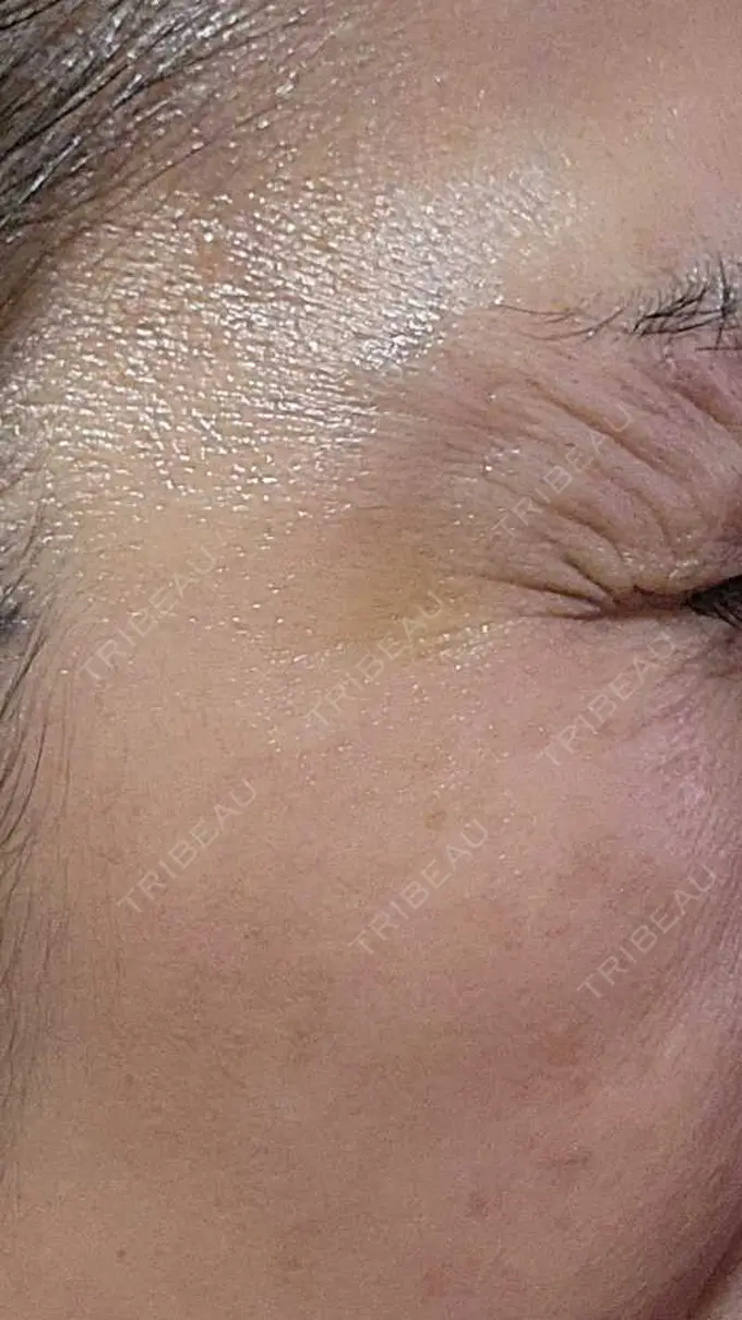 ボトックス（眉間） / ボトックス（目尻） ルラ美容クリニック 広島院 DAY 8 メイン用