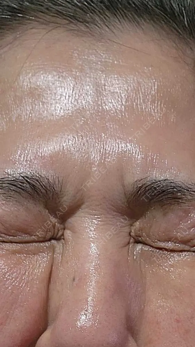 ボトックス（眉間） / ボトックス（目尻） ルラ美容クリニック 広島院 DAY 8 メイン用