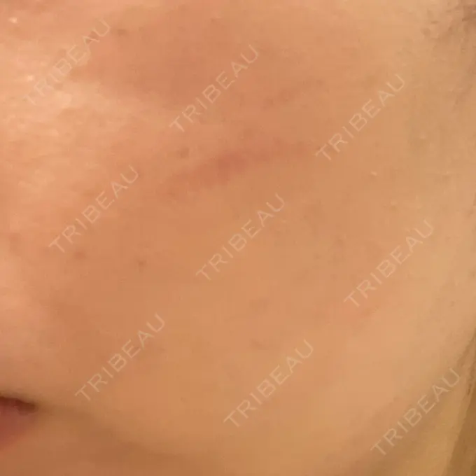 RF（高周波）たるみ治療 表参道メディカルクリニック 表参道院 DAY 4 メイン用