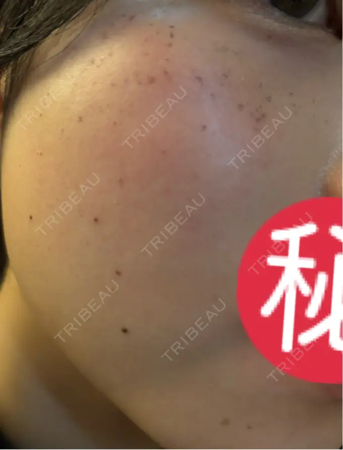 エレクトロポレーション / ルメッカ ゆきスキンクリニック 東池袋 DAY 3 メイン用