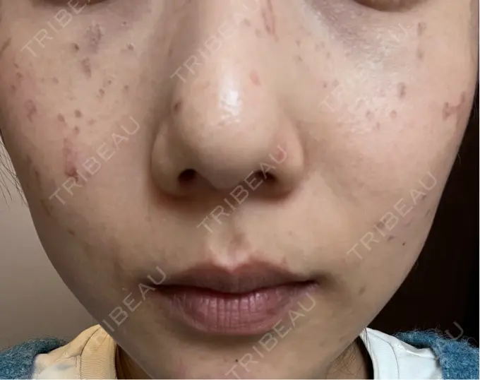 ピコスポット 東京シルククリニック 新宿院 DAY 4 メイン用