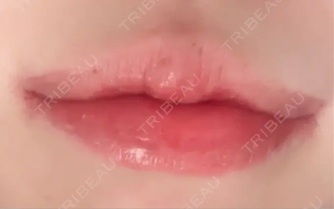 口角挙上 / その他（口元） R Beauty CLINIC 銀座院 DAY 14 メイン用