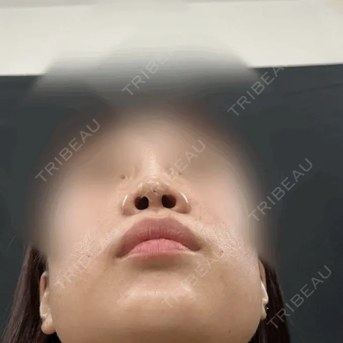 ヒアルロン酸注入（鼻） / ボトックス（あご） / ヒアルロン酸注入（目の下） / ヒアルロン酸注入（こめかみ） / ヒアルロン酸注入（鼻翼基部） / その他（鼻） THE FIRST CLINIC 町田院 AFTER メイン用