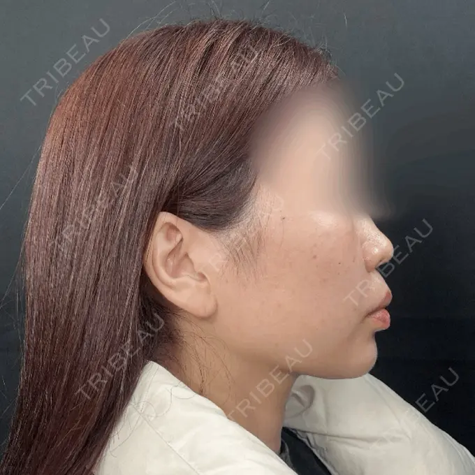 ヒアルロン酸注入（鼻） / ボトックス（あご） / ヒアルロン酸注入（目の下） / ヒアルロン酸注入（こめかみ） / ヒアルロン酸注入（鼻翼基部） / その他（鼻） THE FIRST CLINIC 町田院 DAY 0 メイン用