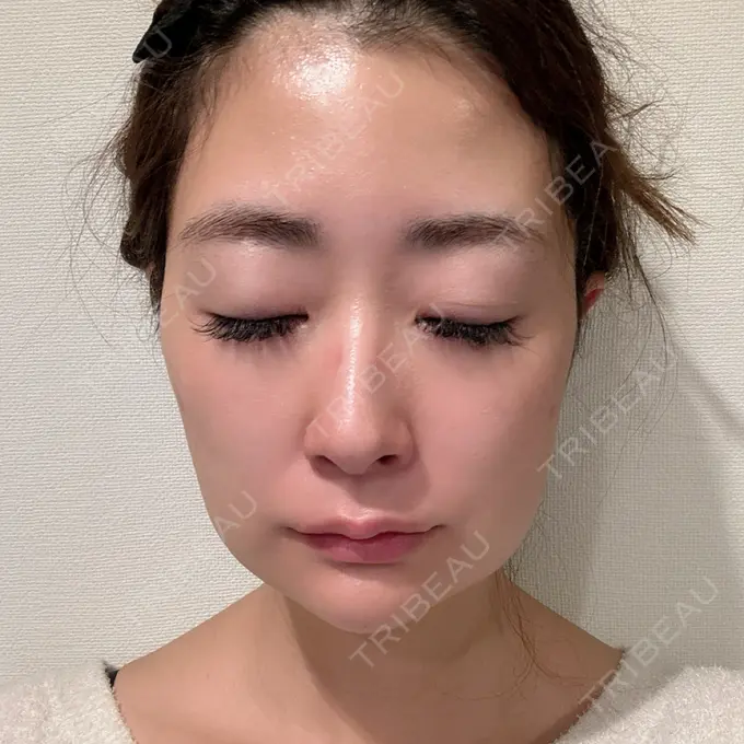 糸リフト / ジョールファット除去 / 脂肪吸引注射（顔） / ボトックス（エラ・小顔） / 脂肪注入（輪郭） ICON CLINIC DAY 6 メイン用