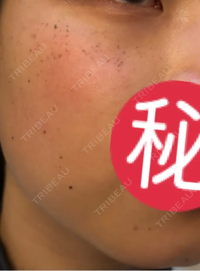 エレクトロポレーション / ルメッカ ゆきスキンクリニック 東池袋 DAY 4 メイン用