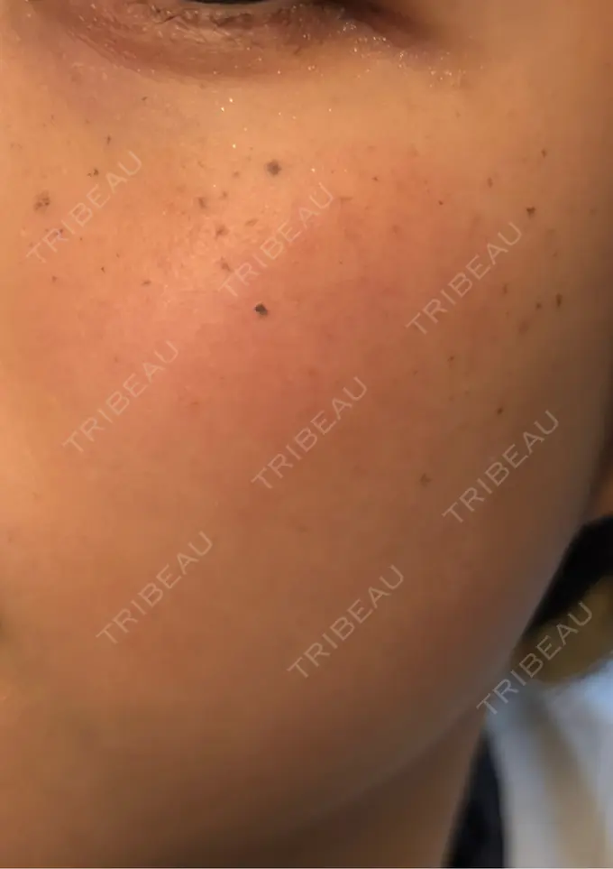 エレクトロポレーション / ルメッカ ゆきスキンクリニック 東池袋 DAY 4 メイン用