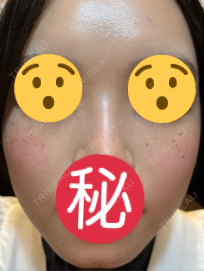 エレクトロポレーション / ルメッカ ゆきスキンクリニック 東池袋 DAY 4 メイン用