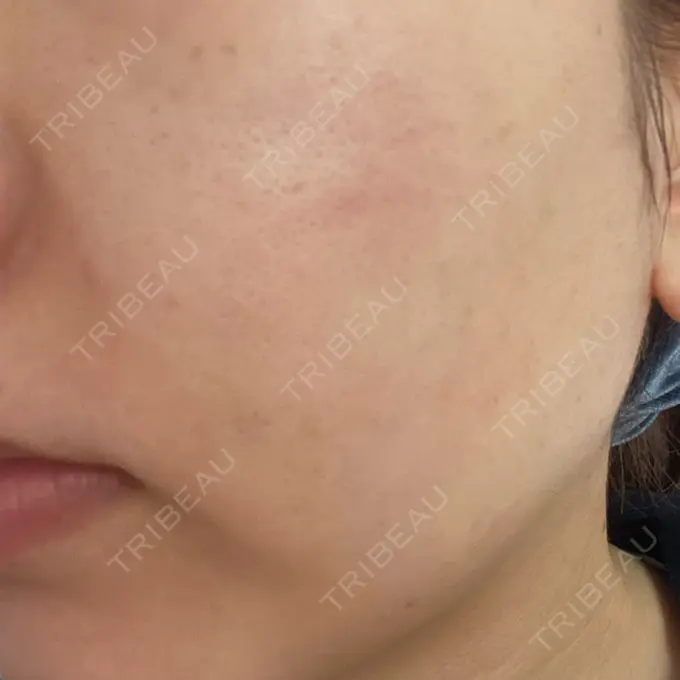 RF（高周波）たるみ治療 表参道メディカルクリニック 表参道院 DAY 5 メイン用