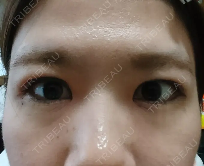 二重埋没 湘南美容クリニック 鹿児島院 AFTER メイン用