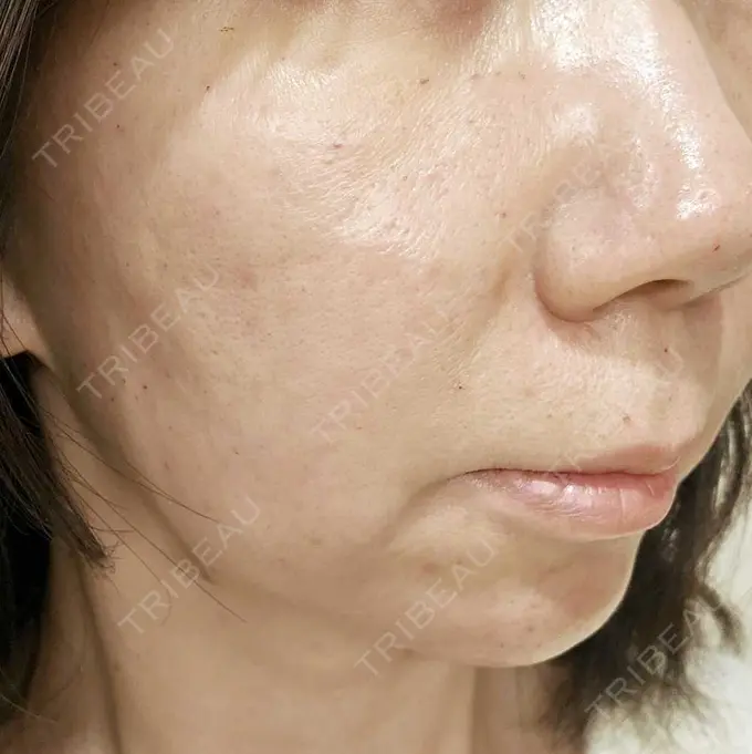 水光注射（ハリ・美肌） 筋肉・美容クリニック DAY 0 メイン用