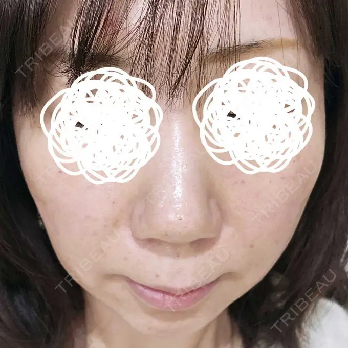 水光注射（ハリ・美肌） 筋肉・美容クリニック DAY 0 メイン用