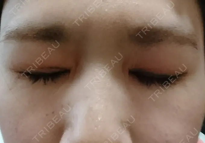 二重埋没 湘南美容クリニック 鹿児島院 DAY 17 メイン用