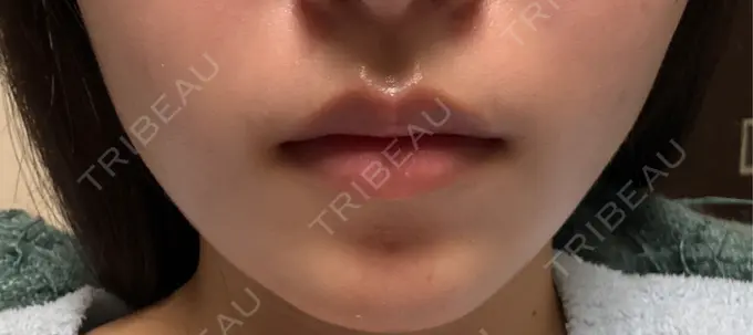 ボトックス（エラ・小顔） 共立美容外科 千葉院 DAY 14 メイン用