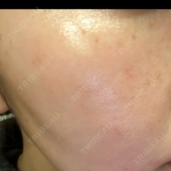 光治療（フォトフェイシャルなど） おおたかの森ビューティークリニック DAY 0 メイン用