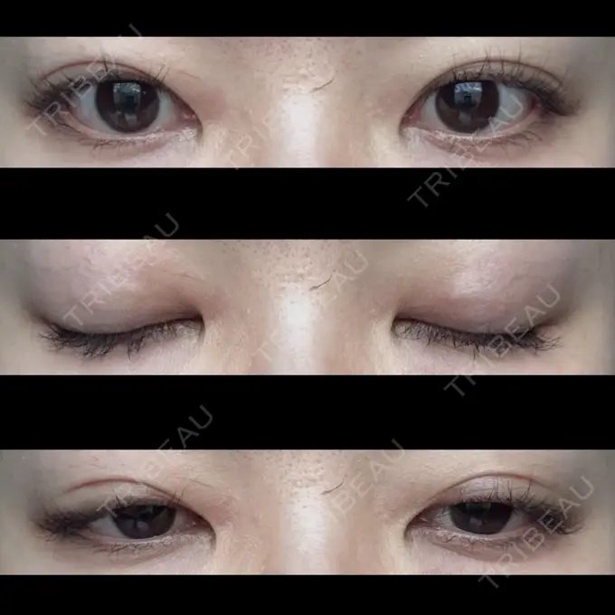 二重埋没 水の森美容クリニック 東京銀座院 DAY 14 メイン用