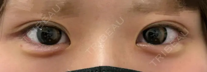 ヒアルロン酸注入（涙袋） フィラークリニック 渋谷院 DAY 0 メイン用