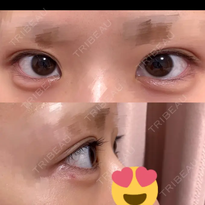 ヒアルロン酸注入（涙袋） フィラークリニック 渋谷院 DAY 1 メイン用