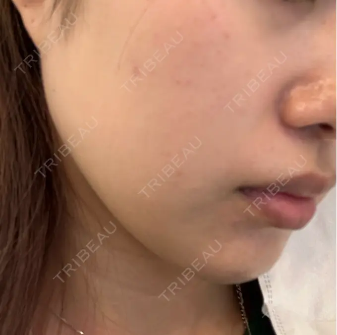 ピーリング（ニキビ・毛穴） おおたかの森ビューティークリニック DAY 9 メイン用