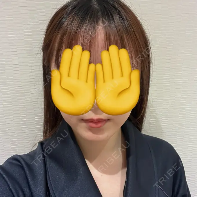 脂肪吸引（顔） Mods Clinic（モッズクリニック） 名古屋院 DAY 106 メイン用