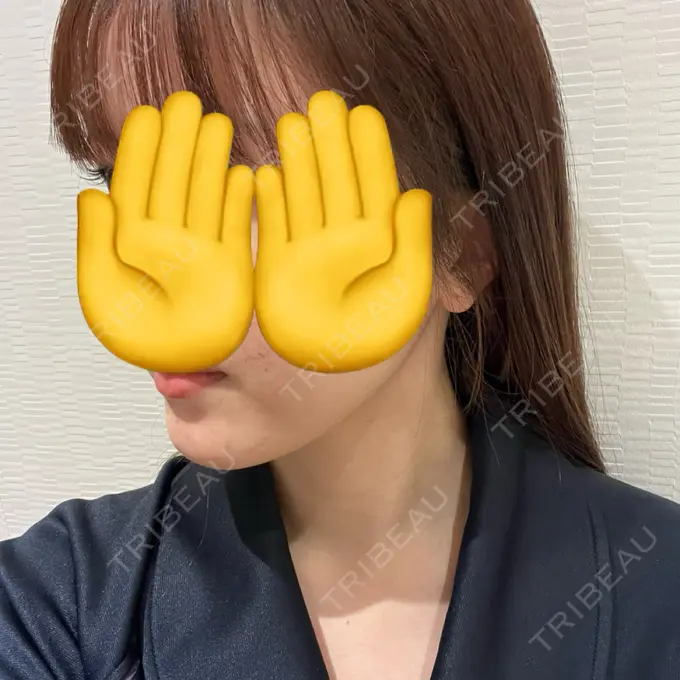 脂肪吸引（顔） Mods Clinic（モッズクリニック） 名古屋院 DAY 106 メイン用