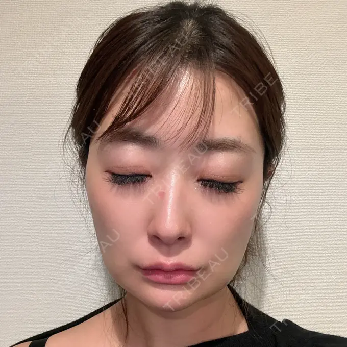 糸リフト / ジョールファット除去 / 脂肪吸引注射（顔） / ボトックス（エラ・小顔） / 脂肪注入（輪郭） ICON CLINIC DAY 7 メイン用