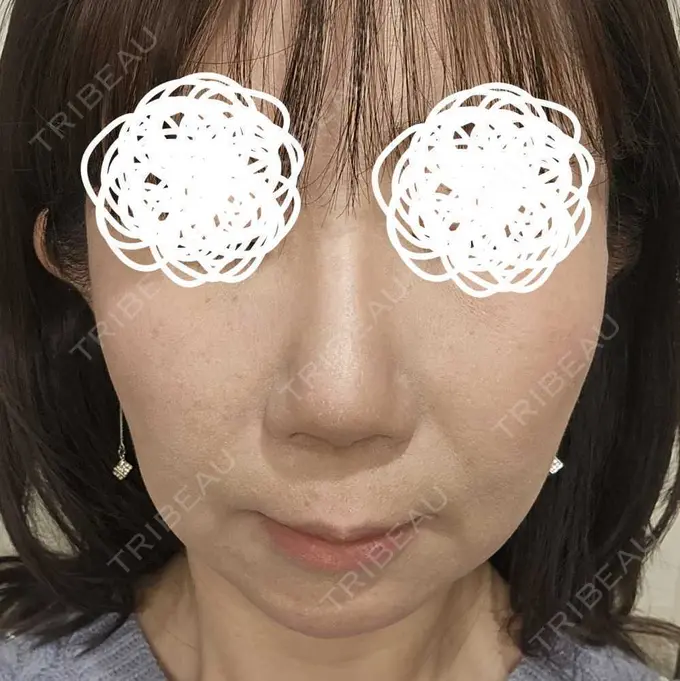 水光注射（ハリ・美肌） 筋肉・美容クリニック DAY 1 メイン用