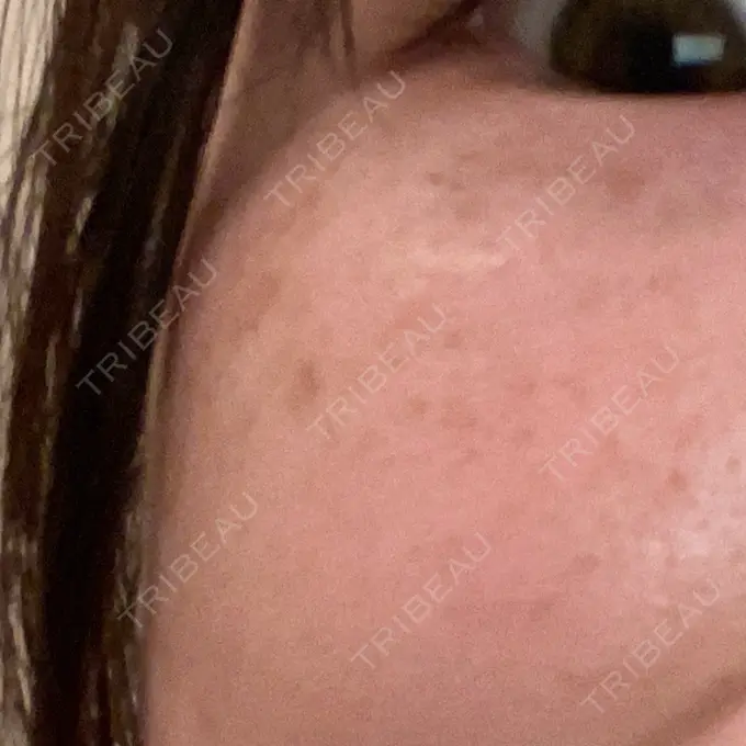 ルメッカ ルラ美容クリニック 大阪本院 AFTER メイン用