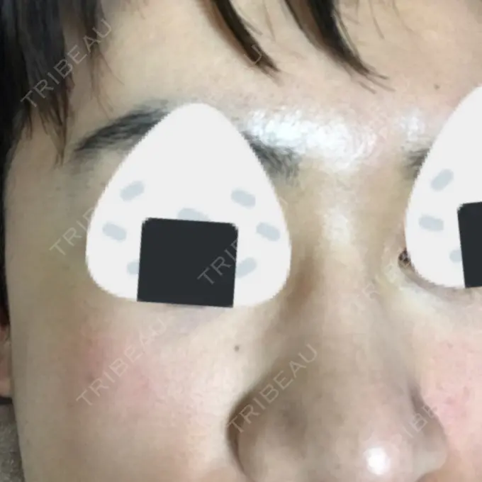 美容点滴・美容注射（美肌） / 美肌レーザー / フラクショナルレーザー（毛穴・ニキビ跡） 飯田橋駅前さくら坂クリニック DAY 5 メイン用