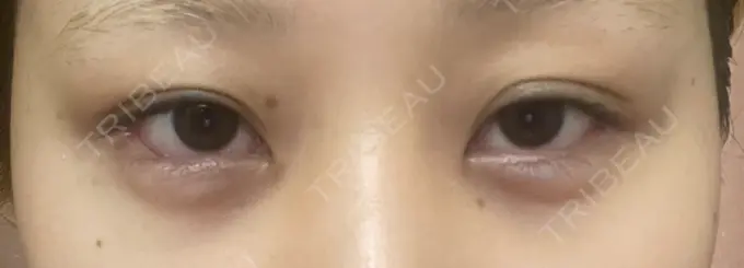 目尻切開 / タレ目形成・グラマラスライン（埋没） / ボトックス（エラ・小顔） LOUIS CLINIC 二子玉川院【ルイクリニック】 DAY 5 メイン用