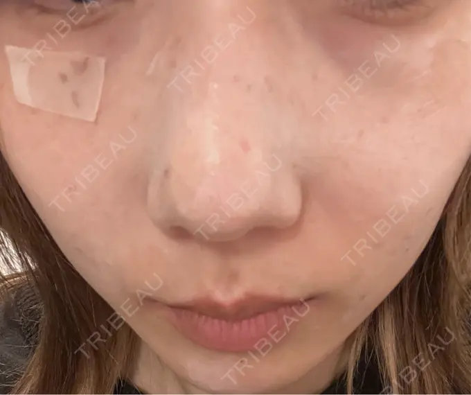 ピコスポット 東京シルククリニック 新宿院 DAY 7 メイン用