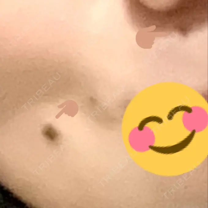 ほくろ・いぼ切除（肌） ルラ美容クリニック 広島院 AFTER メイン用