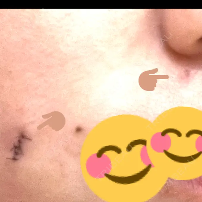 ほくろ・いぼ切除（肌） ルラ美容クリニック 広島院 DAY 2 メイン用