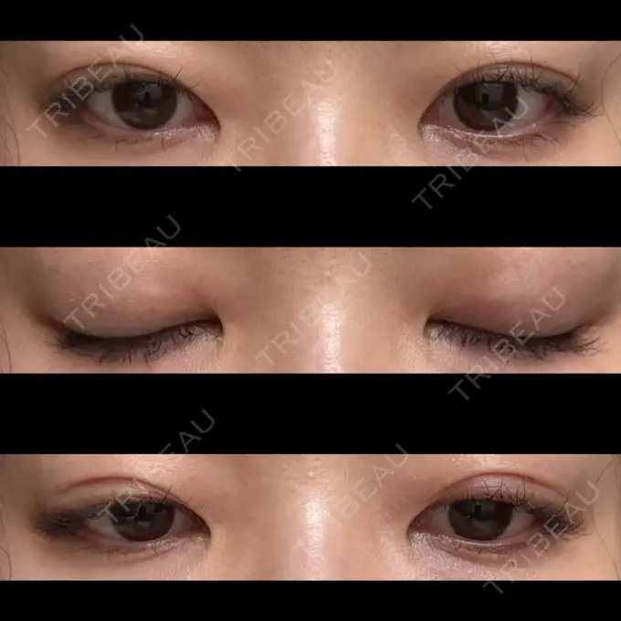 二重埋没 水の森美容クリニック 東京銀座院 DAY 15 メイン用