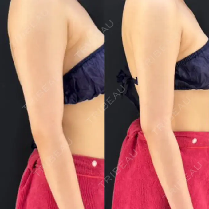 脂肪吸引（二の腕） / 脂肪吸引（肩） HAAB×DREAM BEAUTY CLINIC 東京本院 AFTER メイン用