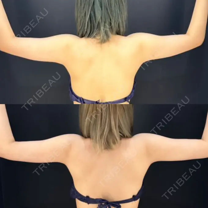 脂肪吸引（二の腕） / 脂肪吸引（肩） HAAB×DREAM BEAUTY CLINIC 東京本院 DAY 89 メイン用