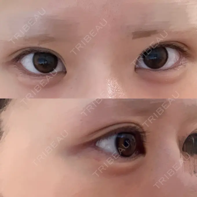 ヒアルロン酸注入（涙袋） フィラークリニック 渋谷院 DAY 2 メイン用