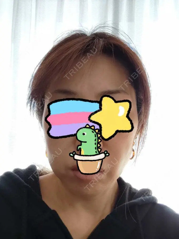 肌ヒアルロン酸注入（たるみ・シワ改善） / シワ取りボトックス TCB東京中央美容外科 越谷院 AFTER メイン用